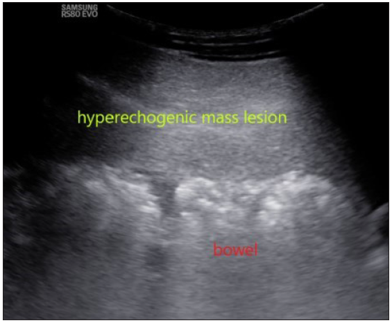 Ultrasound showing a homogeneous echogenic solid mass lesion pushing the bowel loops posteriorly.