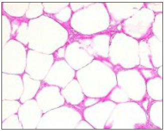 Under high power (original magnification ×40), mature adipocytes are seen with focal areas of fibrosis and fat necrosis without atypical features or lipoblasts.