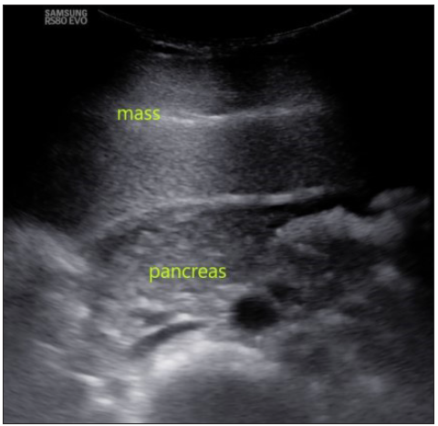 In this ultrasound image, the mass is seen displacing the pancreas and major vessels posteriorly.