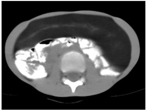 Plain computed tomography (CT) axial section showing large well-defined intra-peritoneal diffuse hypo-attenuating lesion without calcifications.