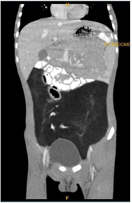 Post-contrast coronal section showing the craniocaudal extent of the lesion and displacement of the bowel loops.