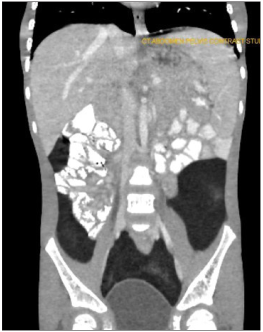 Post-contrast coronal section showing the pelvic extent of the mass.