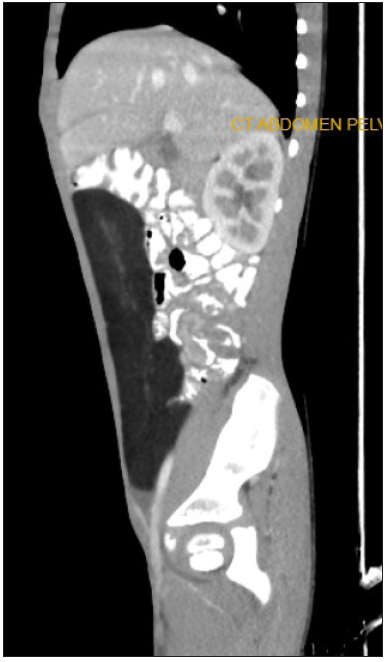 Post-contrast sagittal section showing the mass effect on bowel loops.