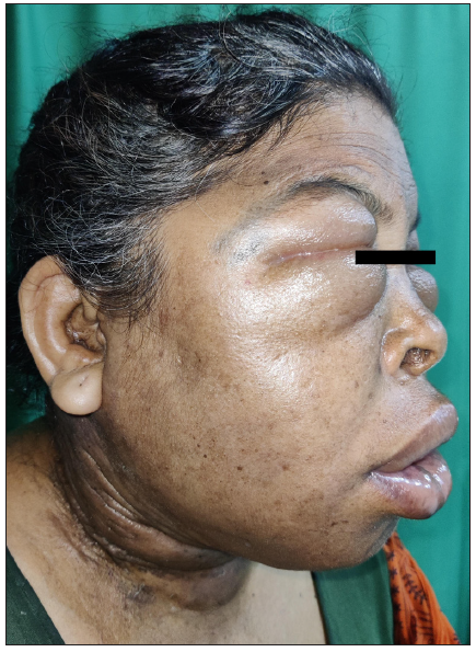 Diffuse facial edema at the time of presentation.