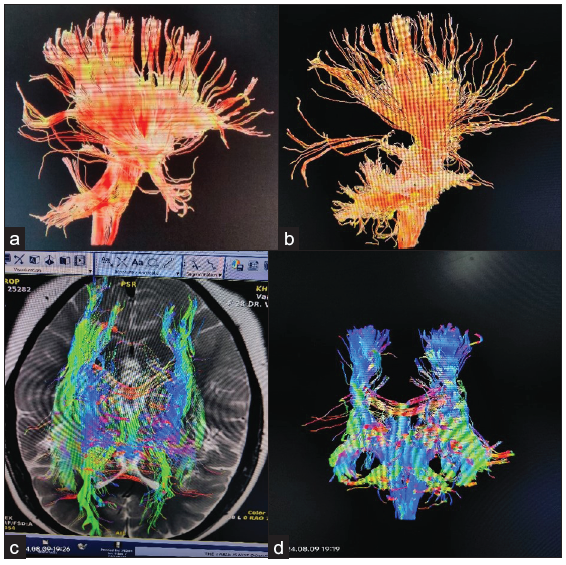 Demonstration the Diffusion Tensor Imaging of white matter tract. (a and b) 3D Sagittal plane of brain nerve fibers shows the detailed anatomy of white matter tract. (c) T2W Axial and (d) Coronal respectively of brain white matter tract shows the connectivity structure of the brain. Bright colors indicate the directionally and integrity of the fiber bundles, indicating the neural communication and connectivity patterns.