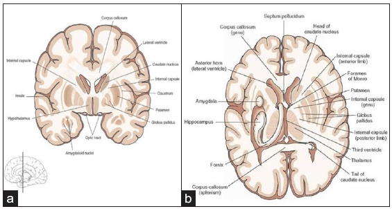 (a) Coronal view and (b) Transverse view of the brain. It consists of myelinated axons, oligodendrocytes, and glial cells; the myelin sheath, produced by the oligodendrocytes, wraps the axons, giving the white matter its color. Myelin sheaths increase velocity and efficiency in the transmission of electrical impulses between different regions of the brain.