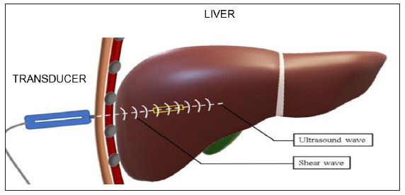 Principles of transient elastography.